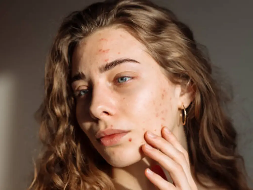 Acne-Prone Skin