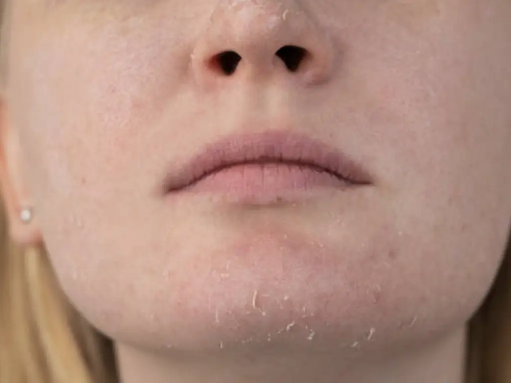 Dry Skin