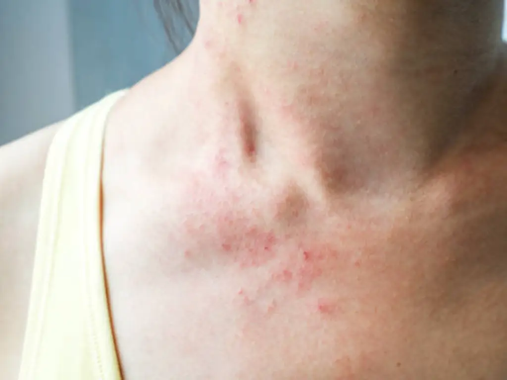 Sensitive Skin (1)