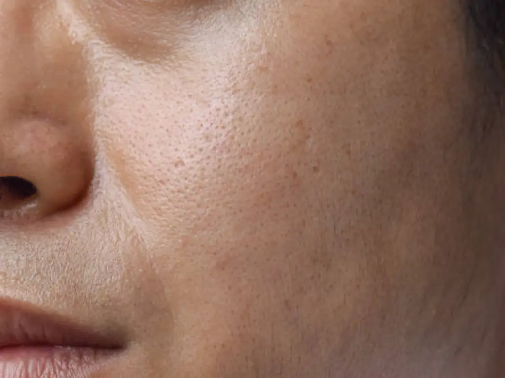 oily skin
